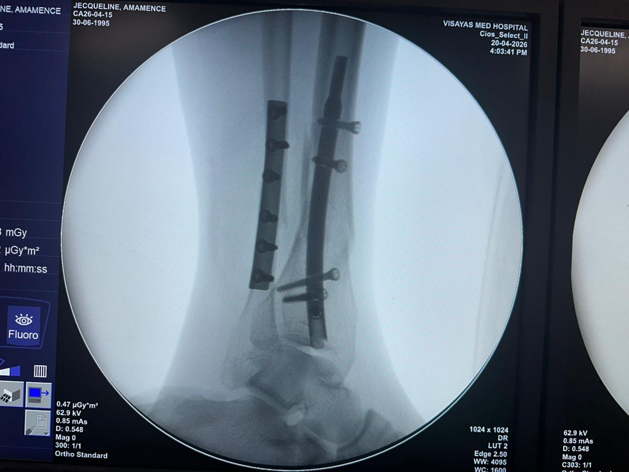 fluoroscopie-perop&eacute;ratoire-clou-tibial-distal-CZMEDITECH