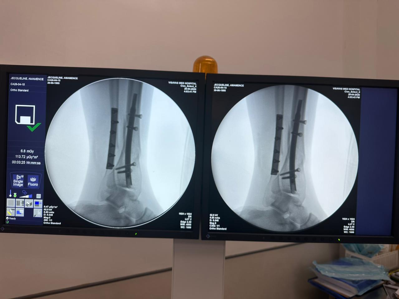 cas-d'ongle-tibial-distal-patient-de-31 ans-ap-view-czmeditech