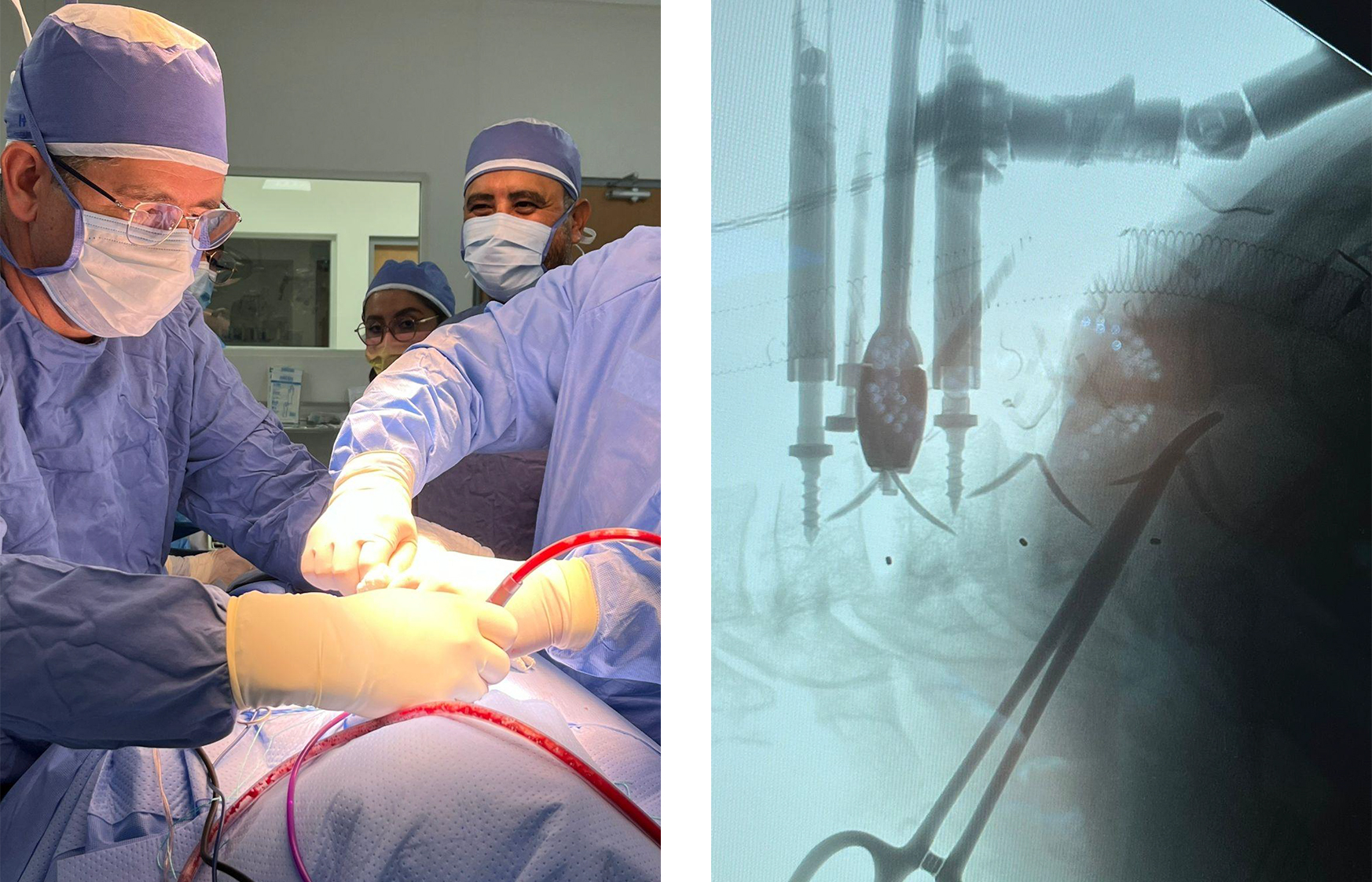 Imagerie pr&eacute;op&eacute;ratoire d'une hernie discale cervicale et proc&eacute;dure de chirurgie en cage Uni-C