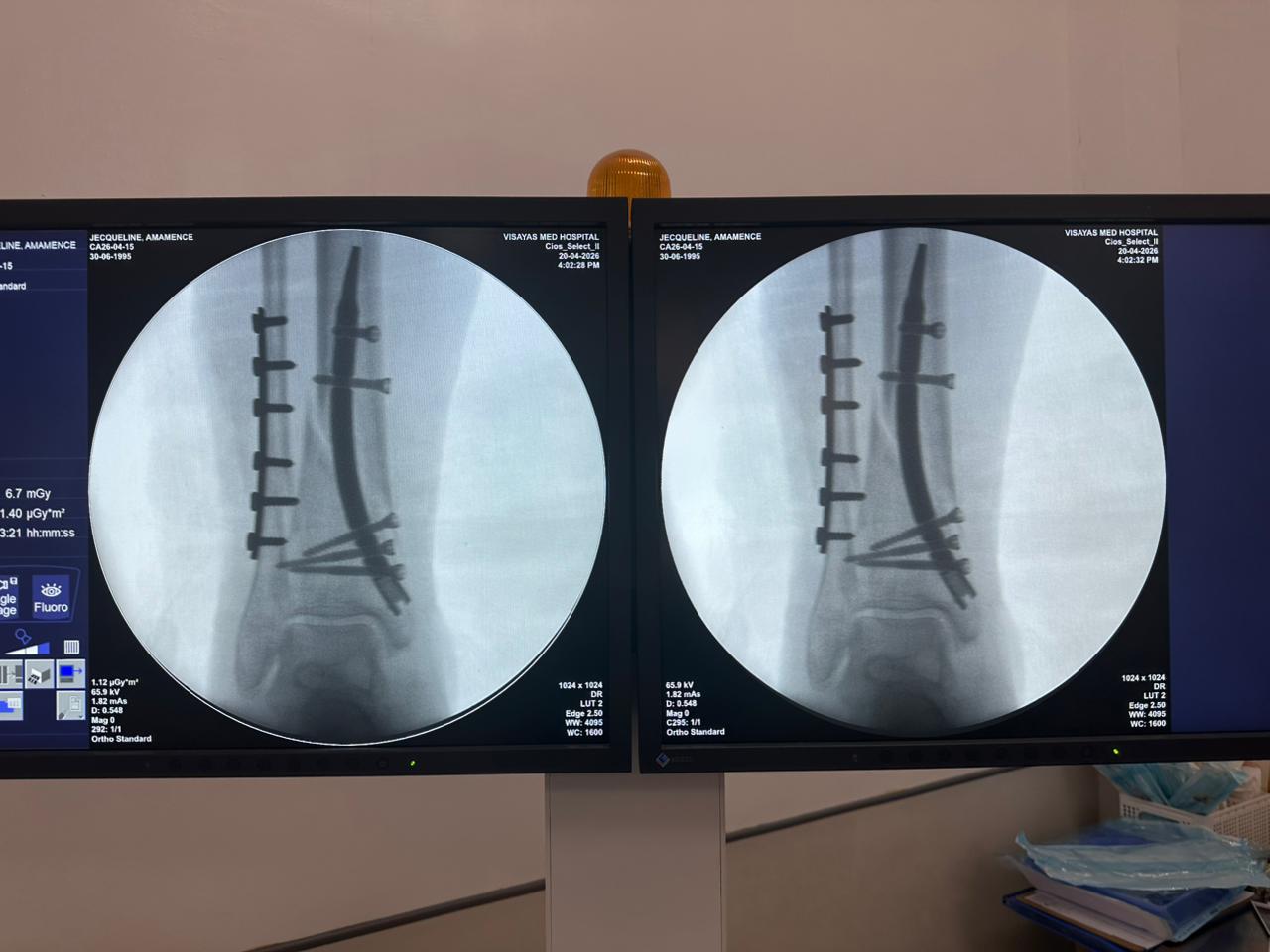 cas-d'ongle-tibial-distal-patient-de-31 ans-vue-lat&eacute;rale-czmeditech