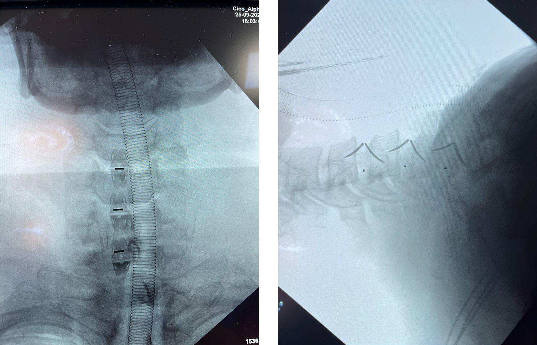 Radiographie cervicale postop&eacute;ratoire apr&egrave;s une chirurgie r&eacute;ussie avec cage cervicale autonome Uni-C