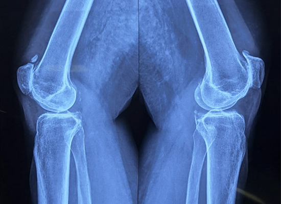 tkr-radiographie-pr&eacute;op&eacute;ratoire-genou-gauche