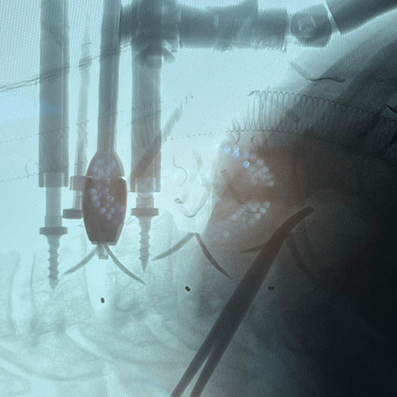 Radioscopie perop&eacute;ratoire de fusion cervicale