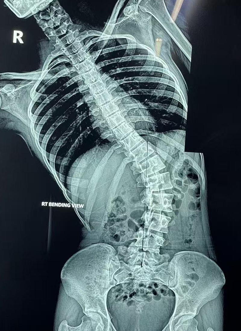 Radiographie AP pr&eacute;op&eacute;ratoire 