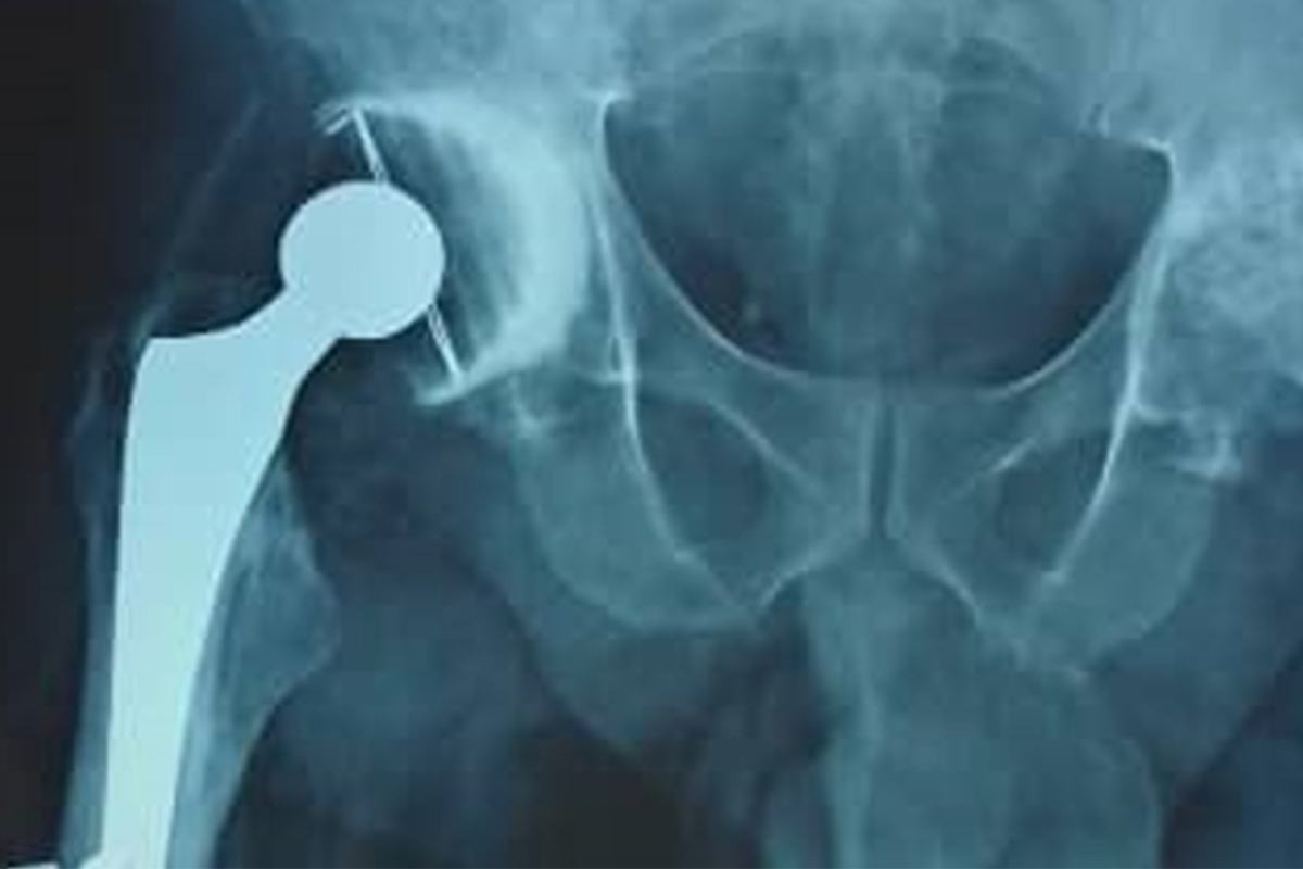Radiographie de contr&ocirc;le deux mois apr&egrave;s arthroplastie totale de hanche droite