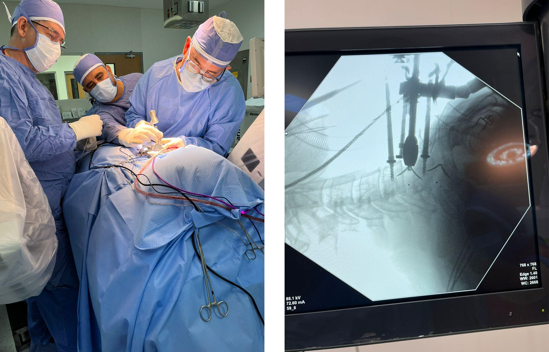 Imagerie pr&eacute;op&eacute;ratoire d'une hernie discale cervicale et proc&eacute;dure de chirurgie en cage Uni-C