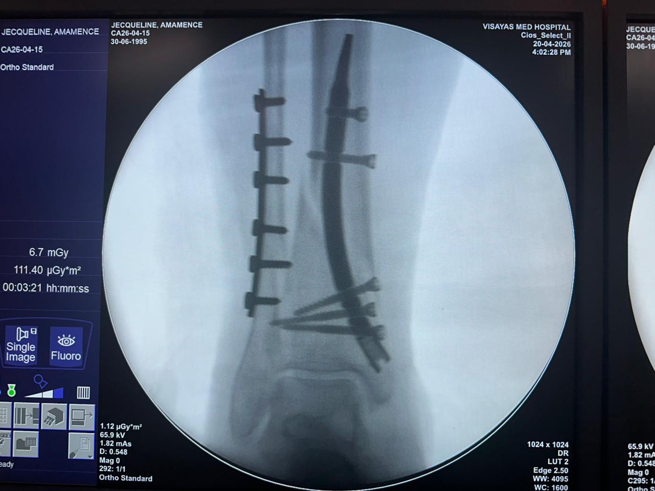 Clou-tibial-distal-fluoroscopie-perop&eacute;ratoire-czmeditech (2)