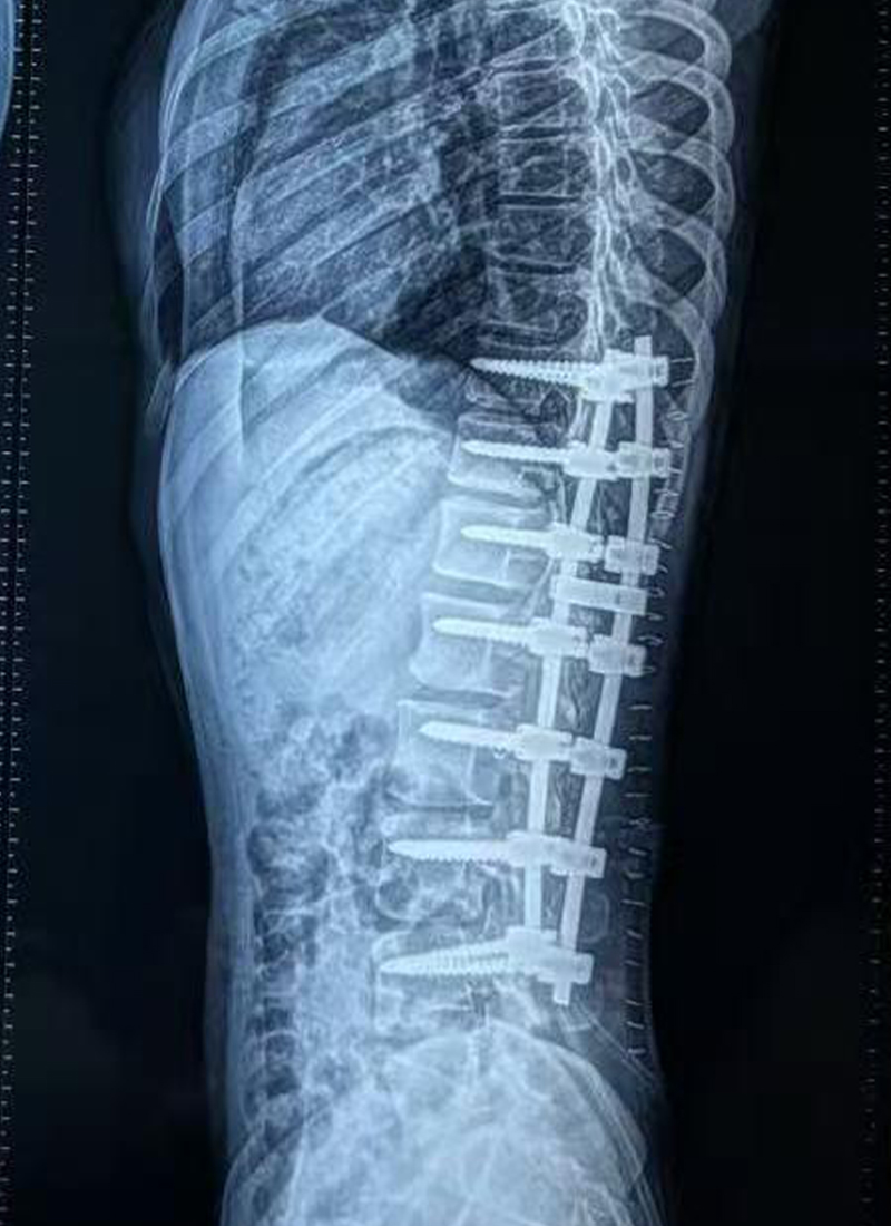 Radiographie lat&eacute;rale postop&eacute;ratoire