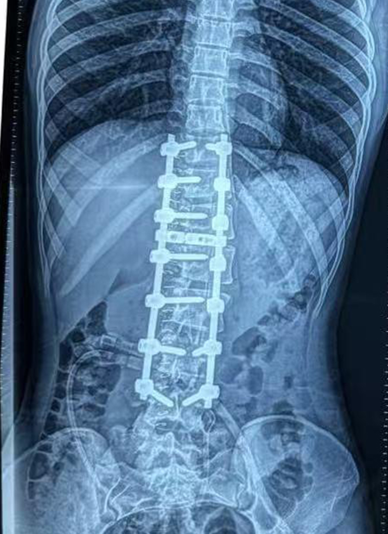 Radiographie AP postop&eacute;ratoire 