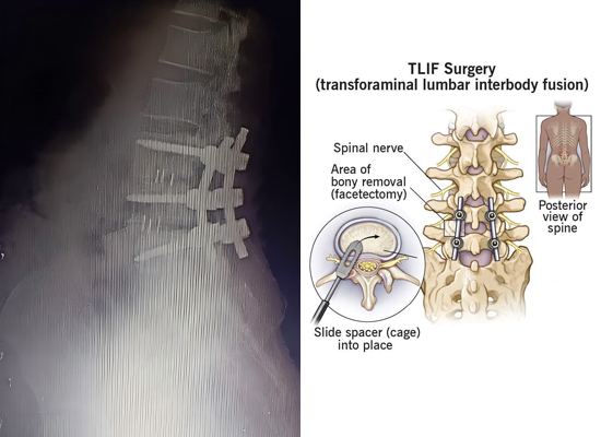 Radiographie postop&eacute;ratoire de fusion de cage TLIF