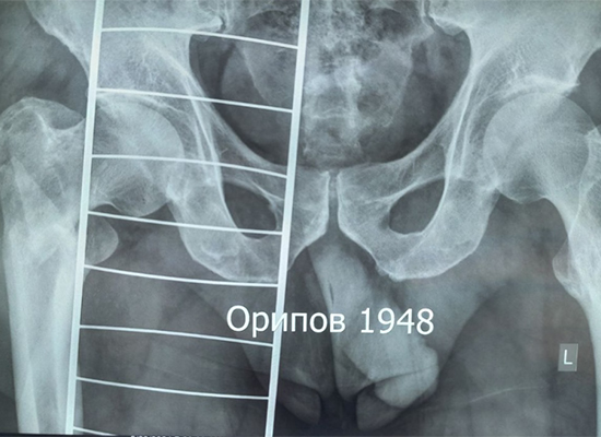 Radiographie pr&eacute;op&eacute;ratoire fracture intertrochant&eacute;rienne comminutive d&eacute;placement varus-CZMEDITECH