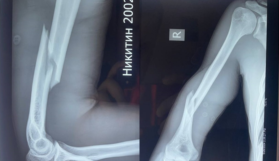 Radiographie pr&eacute;op&eacute;ratoire de fracture de la diaphyse hum&eacute;rale droite 
