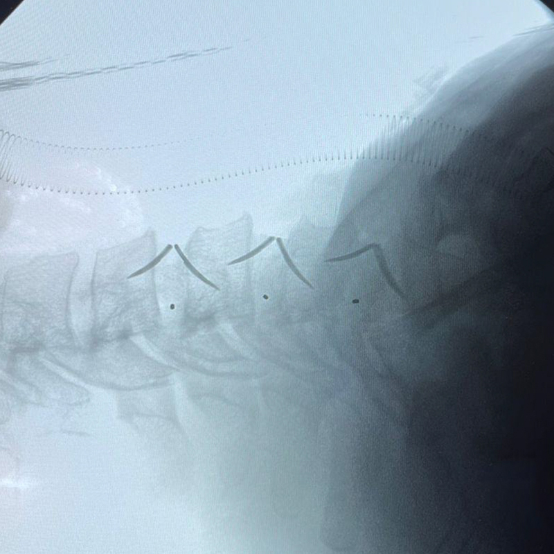 Radiographie postop&eacute;ratoire du rachis cervical lat&eacute;ral