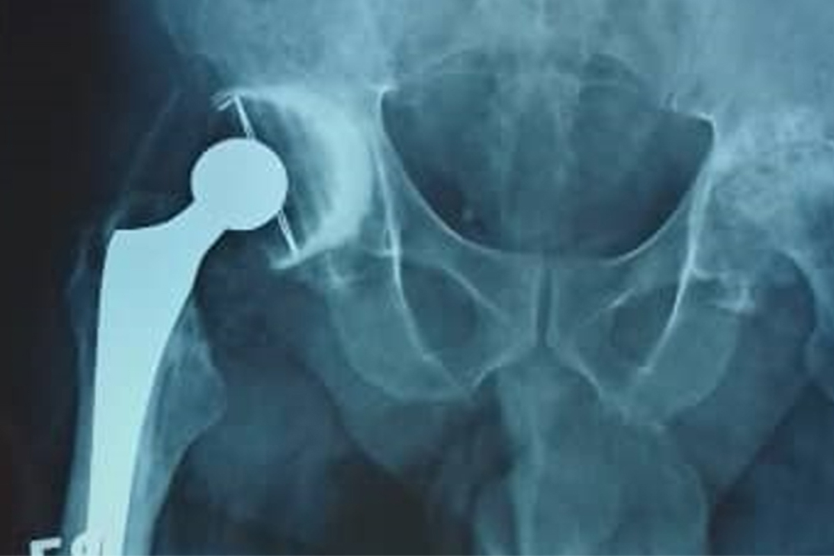 Radiographie postop&eacute;ratoire imm&eacute;diate avec proth&egrave;se de hanche ciment&eacute;e droite 