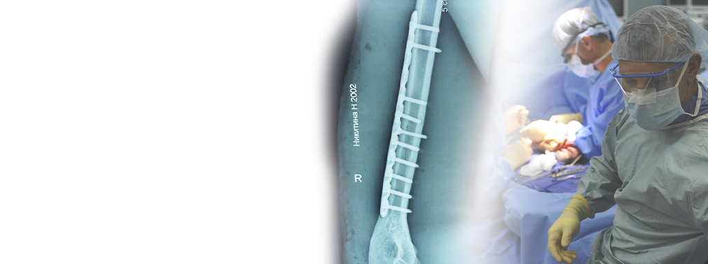 Fracture de la diaphyse hum&eacute;rale droite trait&eacute;e avec une plaque de verrouillage hum&eacute;rale 